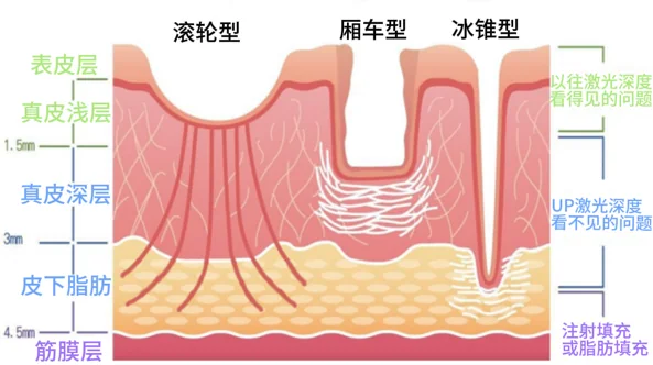 滚轮型、厢车型和冰锥型痤疮瘢痕深度示意
